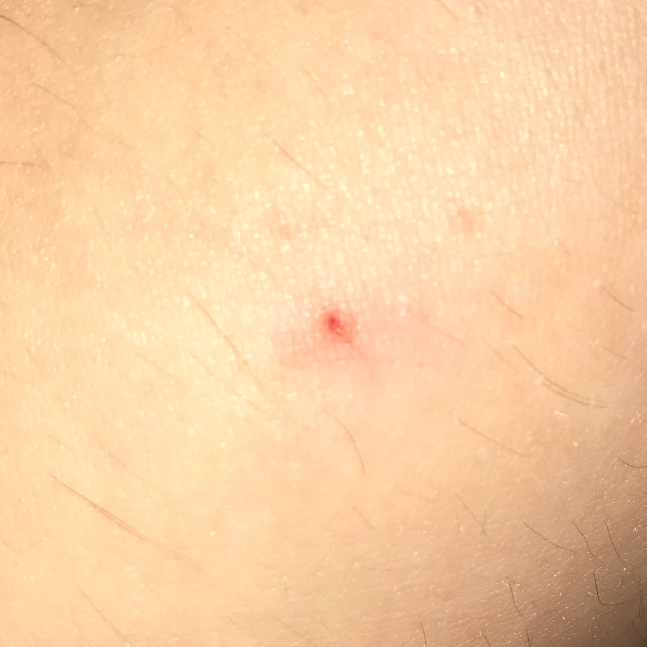 sieht das nach einem zeckenbiss aus? (Gesundheit und Medizin, Zecken, Biss)